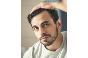 Андрогенетичне випадіння волосся у чоловіків: причини, симптоми та рішення