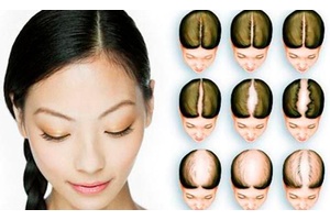 Андрогенетична алопеція у жінок: делікатна проблема, яку не варто ігнорувати